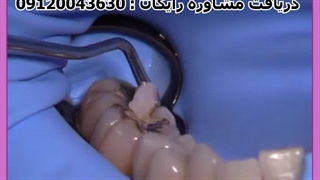 پر کردن دندان