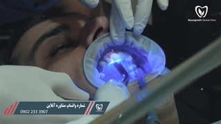 فیلم لمینت سرامیکی دندان در مشهد (کلینیک بزرگمهر)