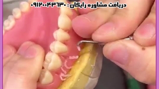 دندان مصنوعی