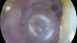 آسیب به پرده گوش در اثر قرارگرفتن جسم خارجی در کانال گوش