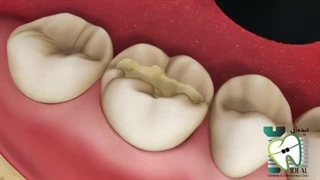 پرکردن دندان با مواد کامپوزیتی (مواد همرنگ دندان)