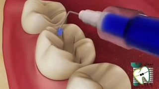 اینله کردن دندان ها چیست؟