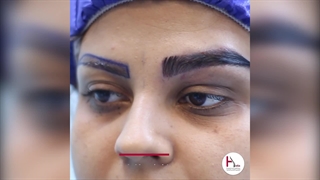 زراعة الحواجب بتقنیة FUT فی عیادة هلیا