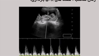 انواع سونوگرافی در دوران بارداری