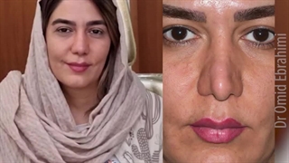 جراحی ترمیمی بینی | دکتر امید ابراهیمی