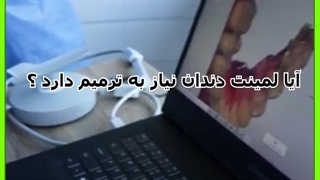 لمینت دندان