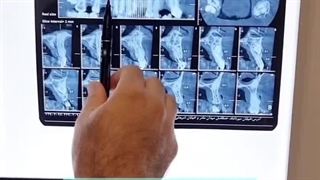 جراحی ترکیبی ایمپلنت و کشیدن دندان نیش نهفته