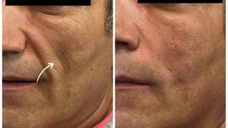 تزریق ژل برای پر کردن صورت