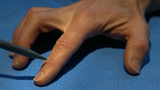 آیا کیست مچ دست خطرناک است؟