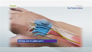 همه چیز در مورد کیست مچ دست