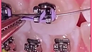 ارتودنسی لیفت ابرو