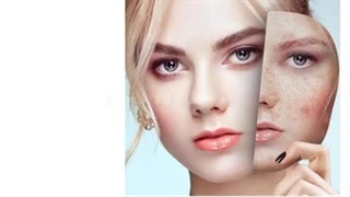 جدیدترین روش برای کلاژن سازی و جوانسازی پوست و رفع چین و چروک های دائمی لیفت گردنایمپلنت دندان