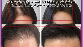 ماندگاری هیر فیلر پاکسازی پوست