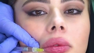 تزریق ژل نچرال صورت