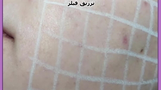 تزریق ژل صورت قبل و بعد لیپوماتیک