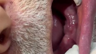 دندان مصنوعی برای لثه صاف - ریتنشن دندان مصنوعی