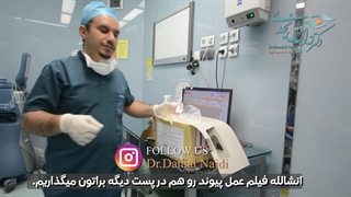 عمل پیوند قرنیه