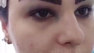 کاشت ابرو دائم در کلینیک آرتین