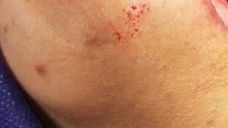 ایمپلنت کار حرفه ای در کلینیک شیان-13