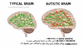 اوتیسم و نقشه مغزی