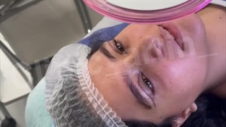 بلفارو‌ چشم گربه‌ای در کلینیک آرتین