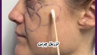تزریق چربی چگونه انجام می شود؟