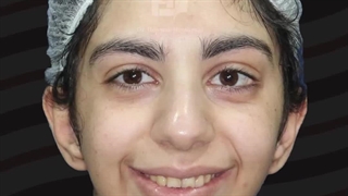 جراحی جلو آوردن و اصلاح فرم چانه