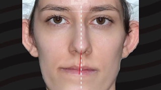 جراحی همزمان دو فک و چانه