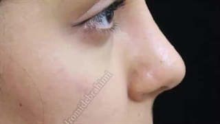 دو ماه پس از جراحی بینی استخوانی و قوزدار