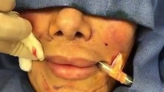 تزریق چربی به لب لیپوست