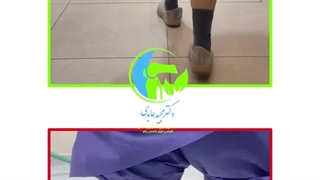 تعویض مفصل زانو به طور همزمان