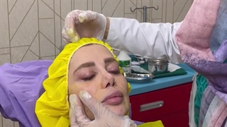 لیفت و کلاژن سازی صورت با نخ