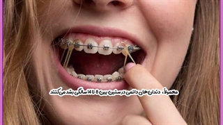 ارتودنسی کاشت مو