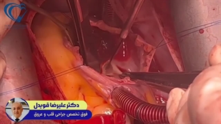 تومور بزرگ قلب راست