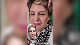 Scarless Blepharoplasty - Natural and Long-lasting Results