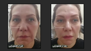 نمونه کار هایفوتراپی