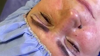 جراحی پلک بالا در کلینیک آرتین