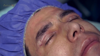 بلفاروپلاستی در بهترین کلینیک پوست و مو مشهد