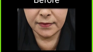 چال گونه ابرسانی پوست