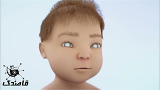 انواع آب مروارید و جراحی