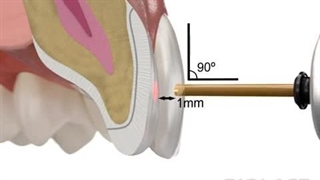 Waterlase Veneer Removal Clinical Animation