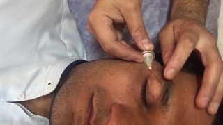 جوانسازی ناحیه دور چشم با دستگاه پزشکی Carboxy Therapy لیزر صورت