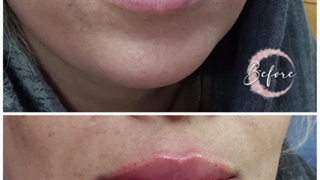 تزریق ژل لب با فرم طبیعی