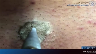 قاتل زگیل تناسلی مردان