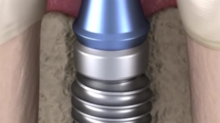 عوامل موثر بر پایداری ریشه های ایمپلنت