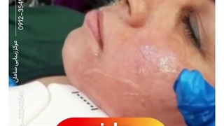 هایفو صورت در کرج