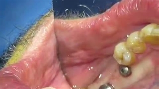 ایمپلنت پانچ با متخصص ایمپلنت (قسمت دوم )