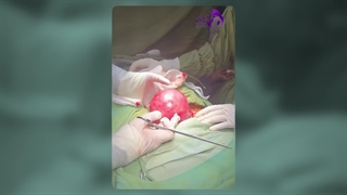 عمل فیبروم رحم