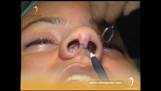 فیلم کامل جراحی بینی | عمل زیبایی بینی