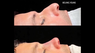 نمونه کار عمل زیبایی بینی | جراحی بینی